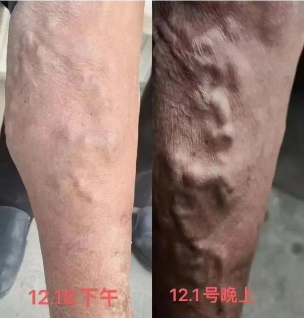 百年纳用户案例分享:静脉曲张